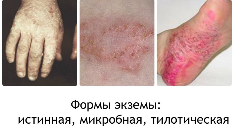 формы экземы